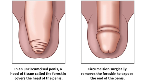 Circumcision